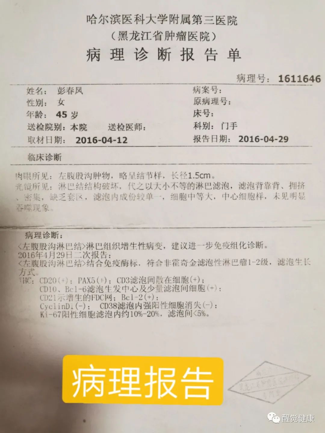 癌症和生活方式结缘有关吗_什么是癌症结疗_癌症的结节是什么意思