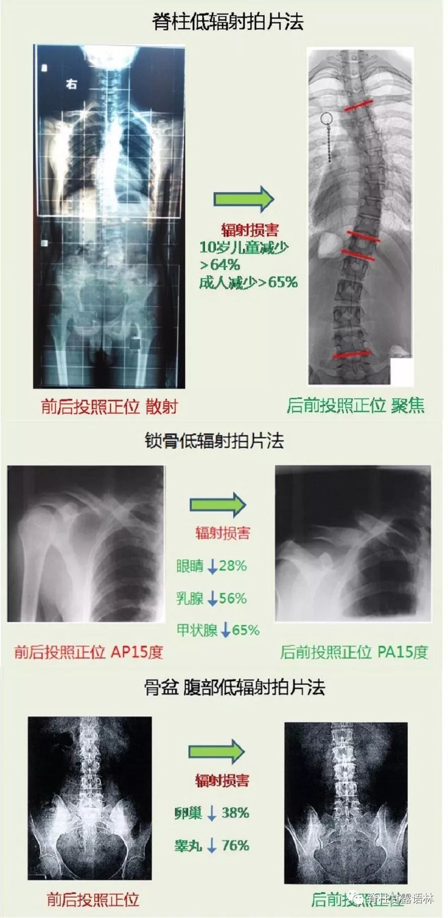 腰椎运动操_运动对腰椎_腰椎运动康复训练